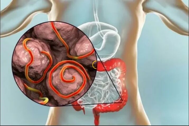 Parasites dans le corps humain