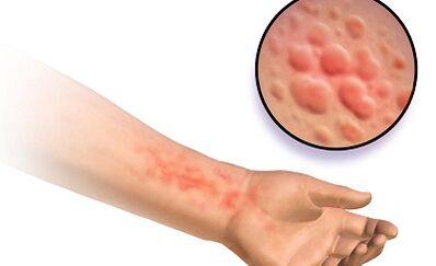 Manifestations de schistosomose chez l'homme